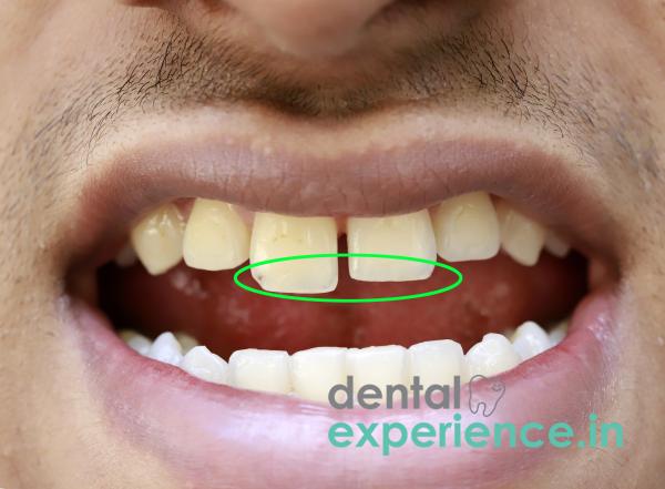 Long Tooth